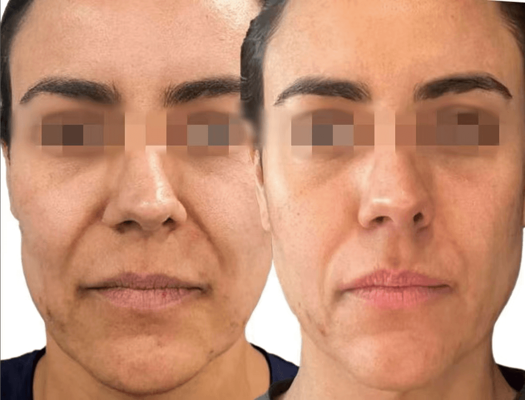 Endolifting treatment — face and neck tightening