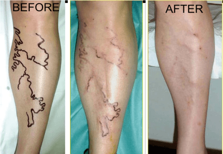EVLT endovenous laser vein ablation