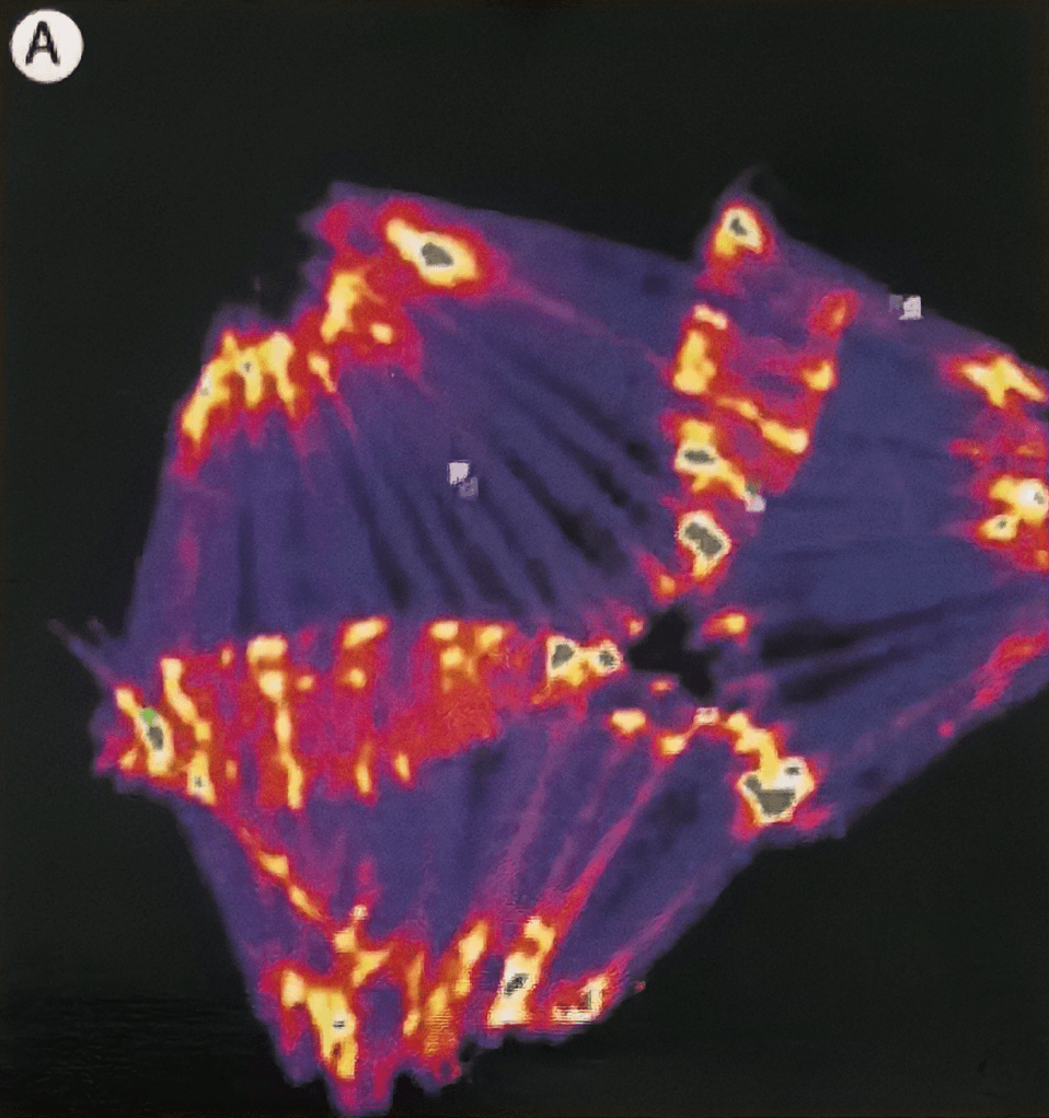 Laser lipolysis through a micro-cannula