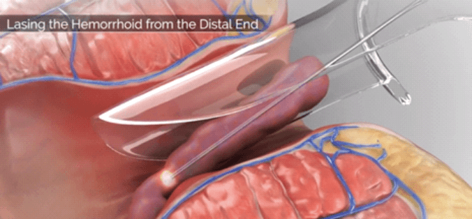 Proctology — fistula and haemorrhoid laser treatment