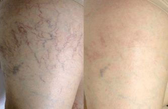 Spider vein treatment on legs and face
