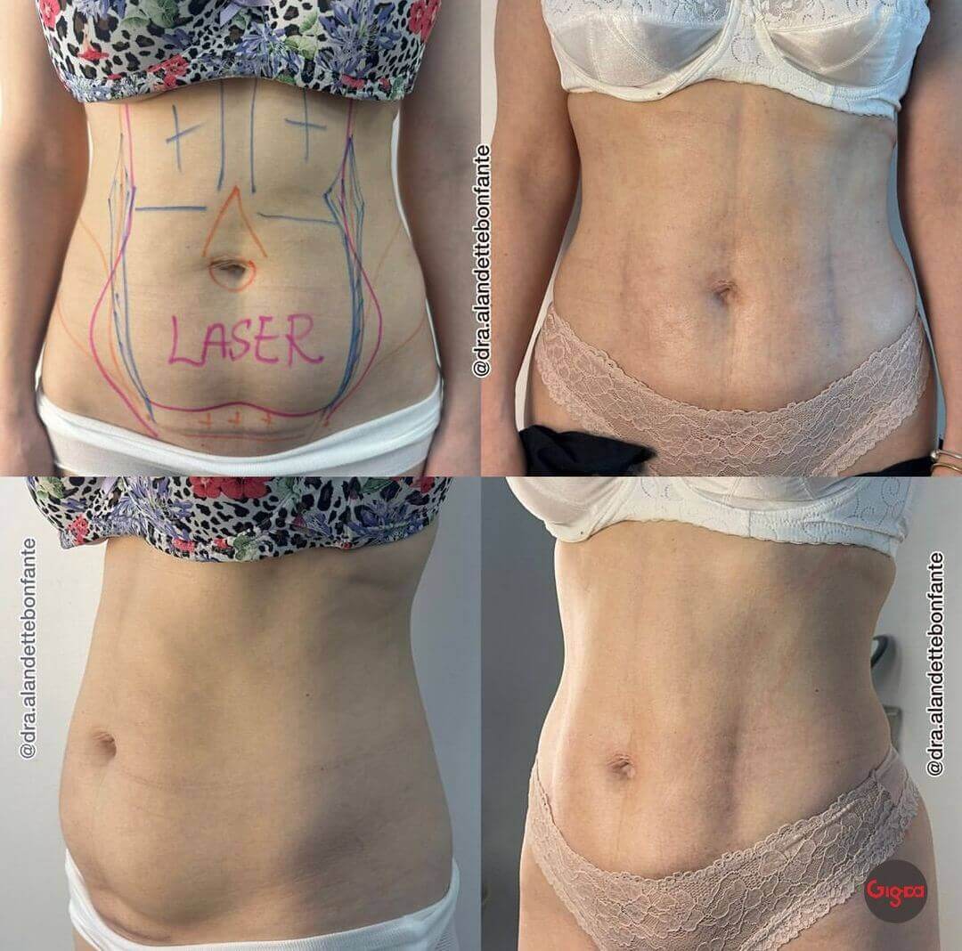 Laser-assisted lipolysis of the abdomen, before and after