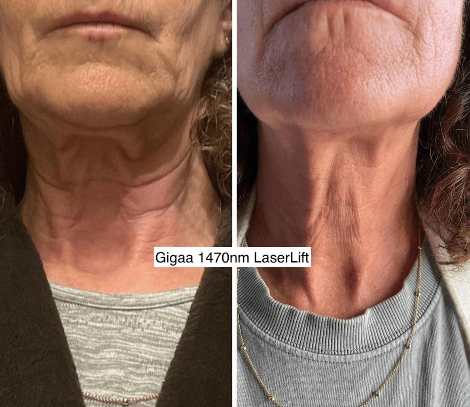 Endolifting 1470nm neck treatment, before and after